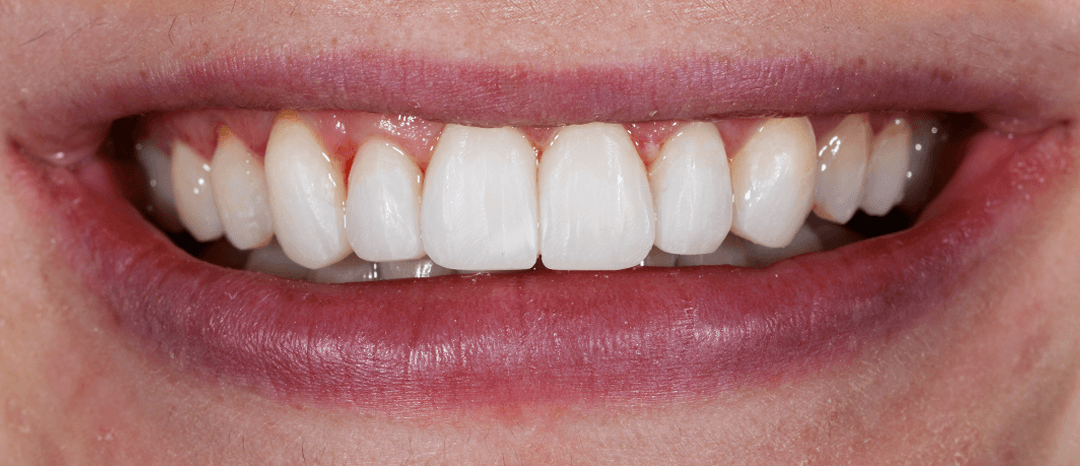 Peta after treatment