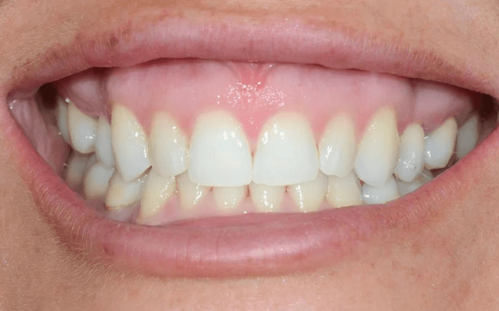 Sarah after treatment