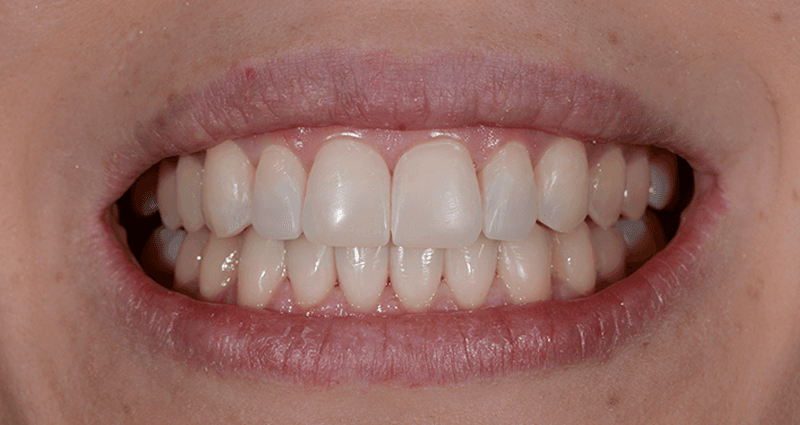 Simone after treatment