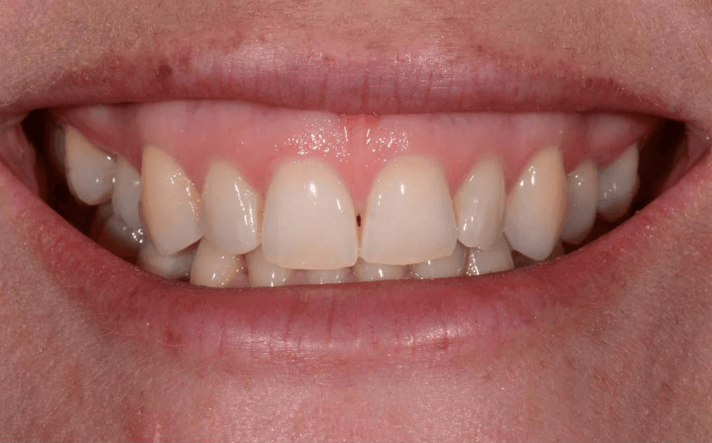 Sarah before treatment