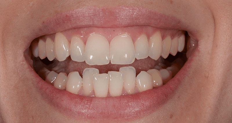 Simone before treatment