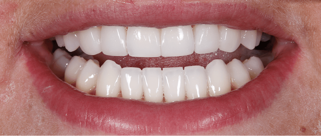 Katie after treatment