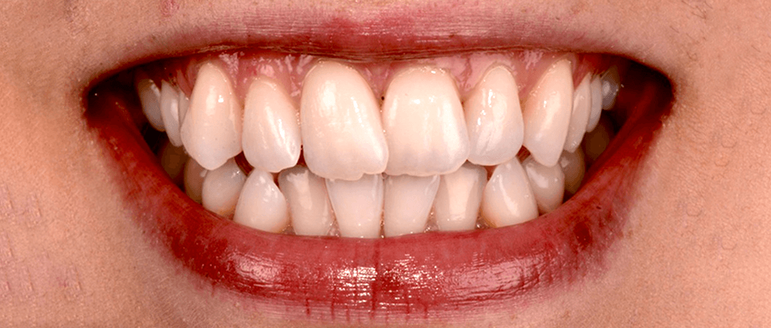 Natalie before treatment